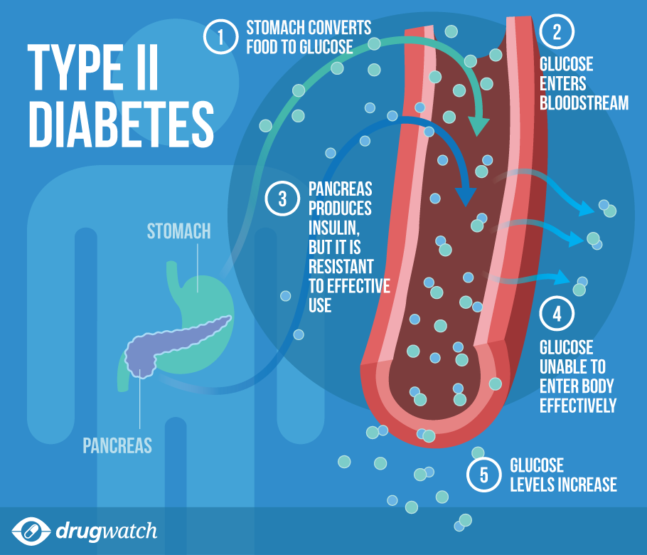 type 2 diabetes