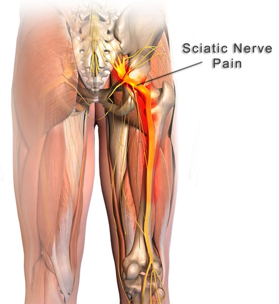 How to Relieve Sciatic Nerve Pain (Do These 9 Odd ...